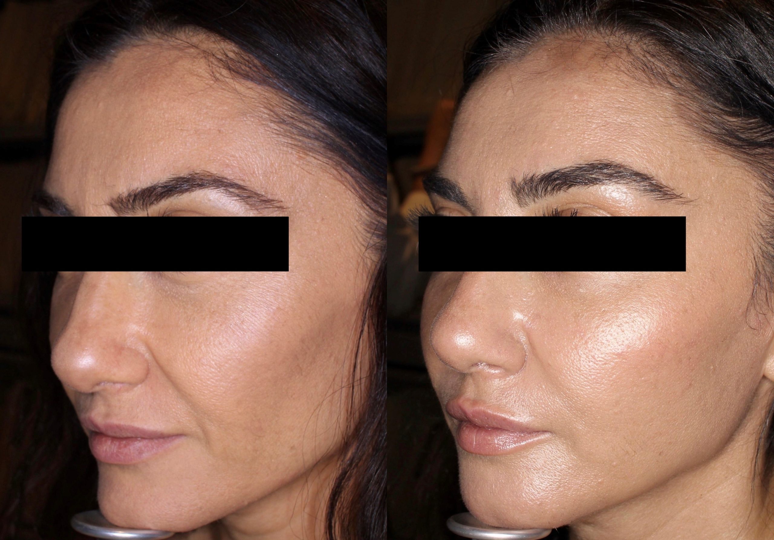 Before and after dermal filler results for a Beautech patient