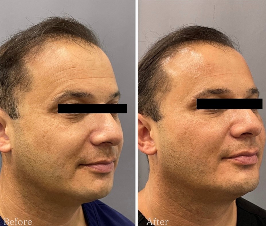 Before and after facial contouring results for a male Beautech patient