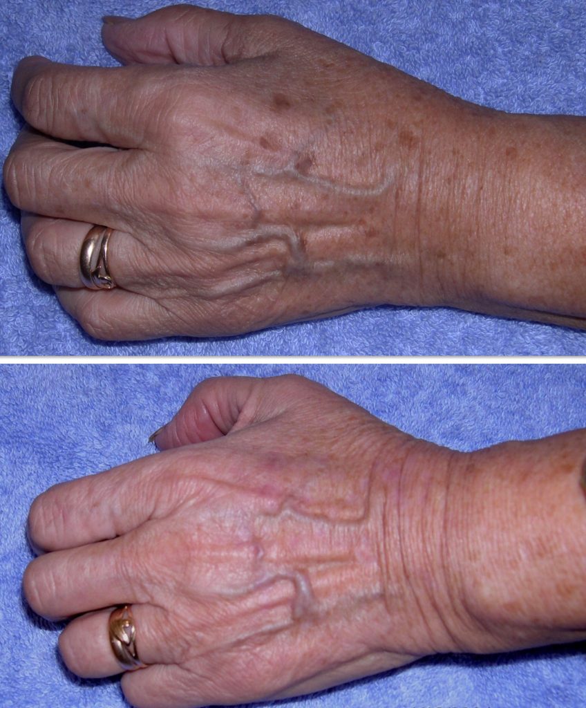Before and after hand treatment results