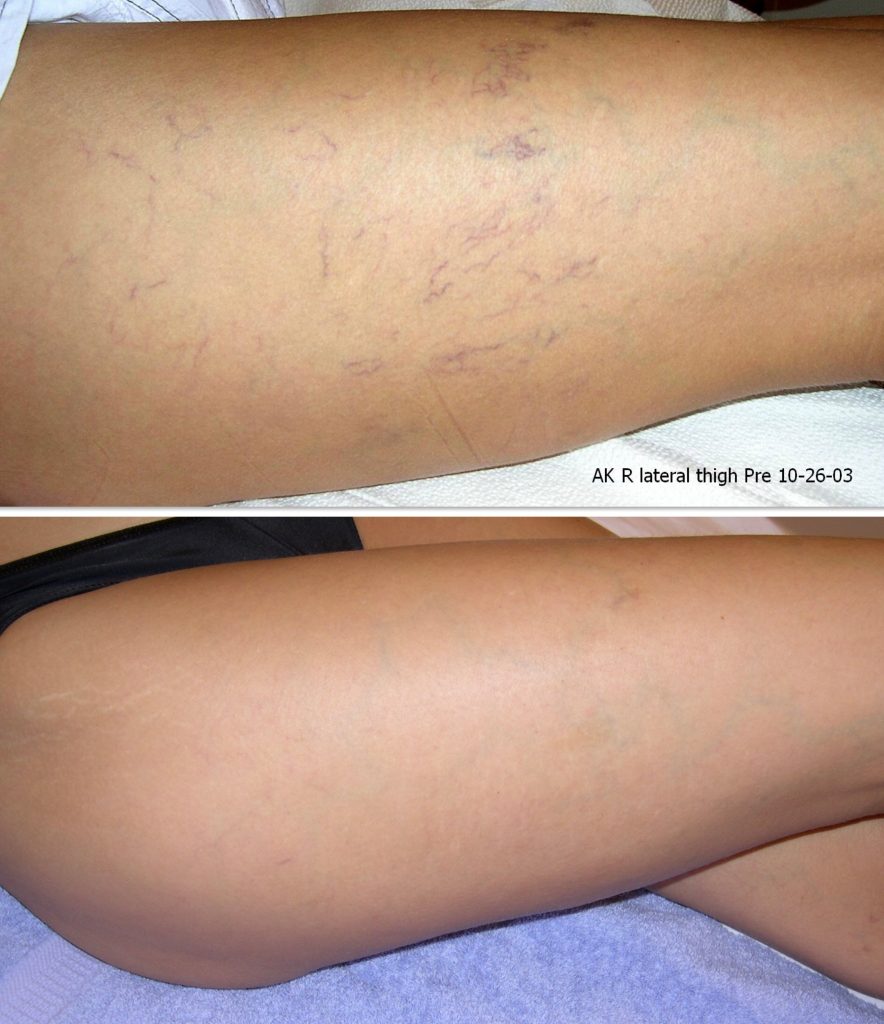Before and after leg vein removal