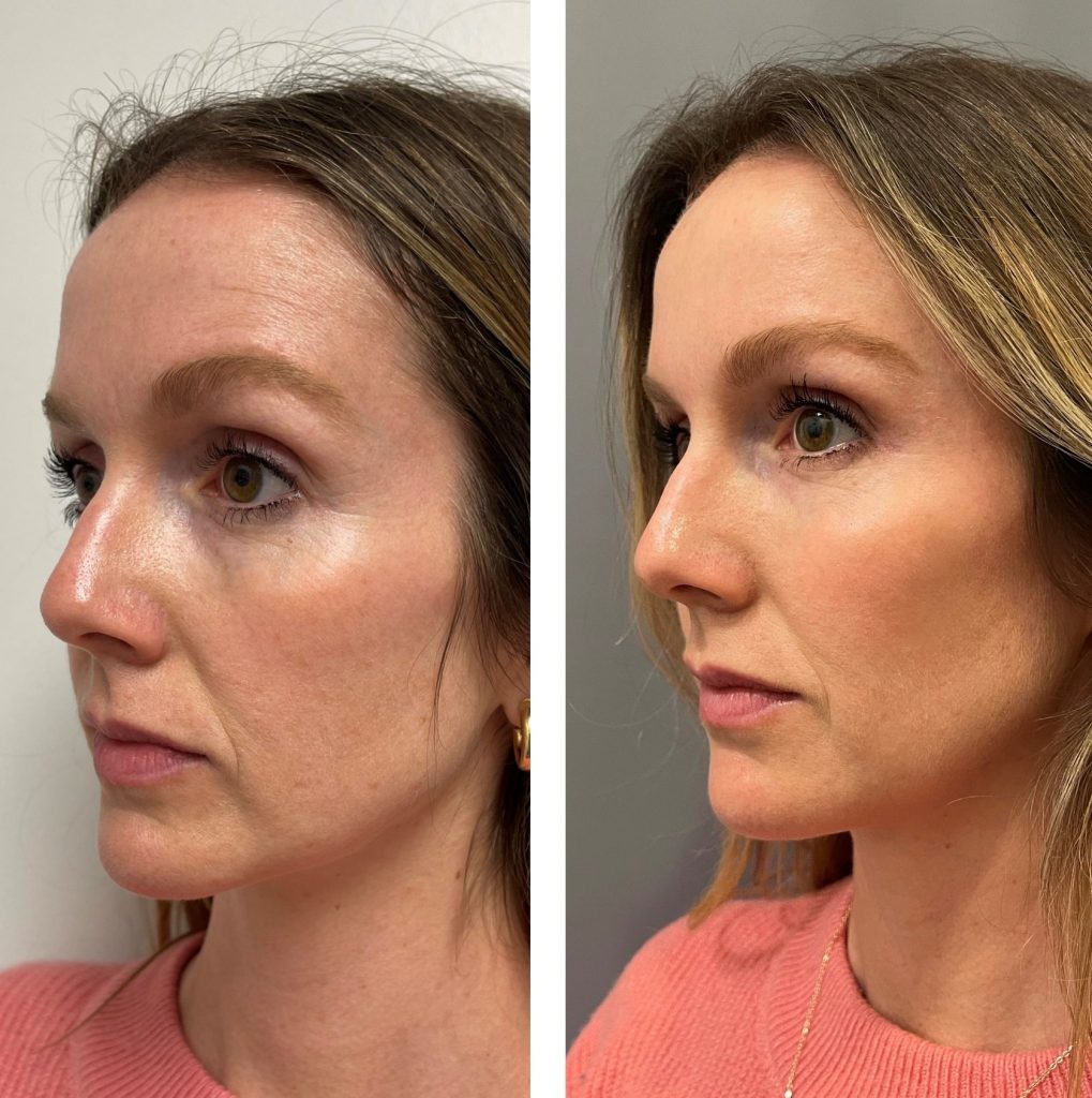 Before and after result photos for a female Beautech patient