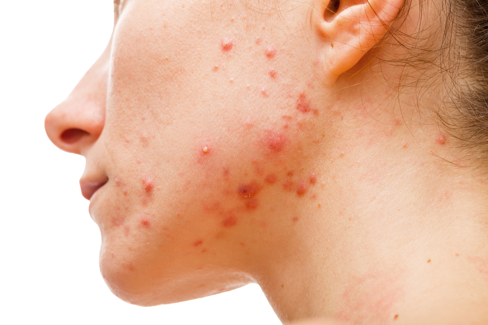 Photo of a cystic acne on a woman's face