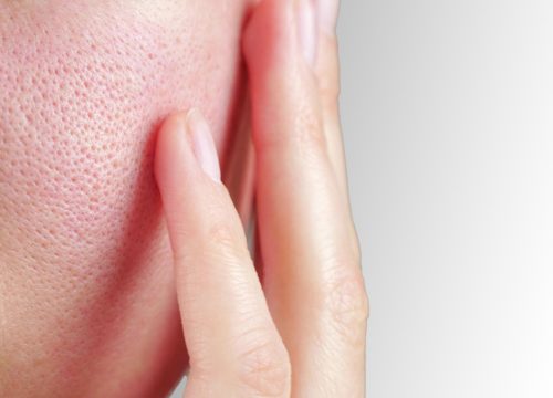 Photo of a woman's face with enlarged pores on her cheek