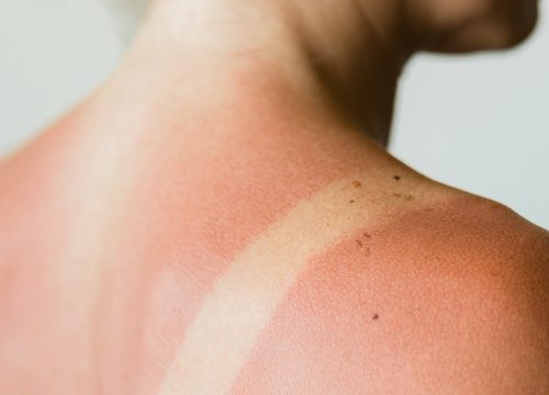 Photo of a woman with a sun burn on her shoulders