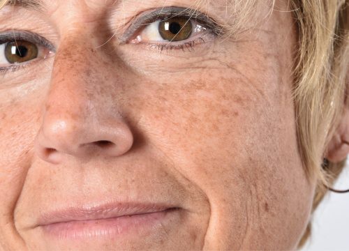 Photo of a woman's face with pigmented lesions