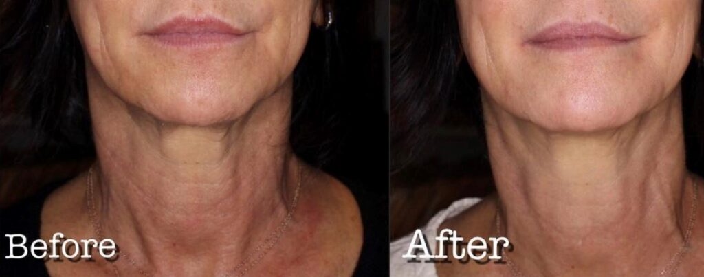 Before and after microneedling results