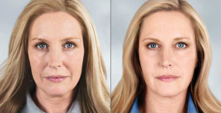 Before and after Sculptra results