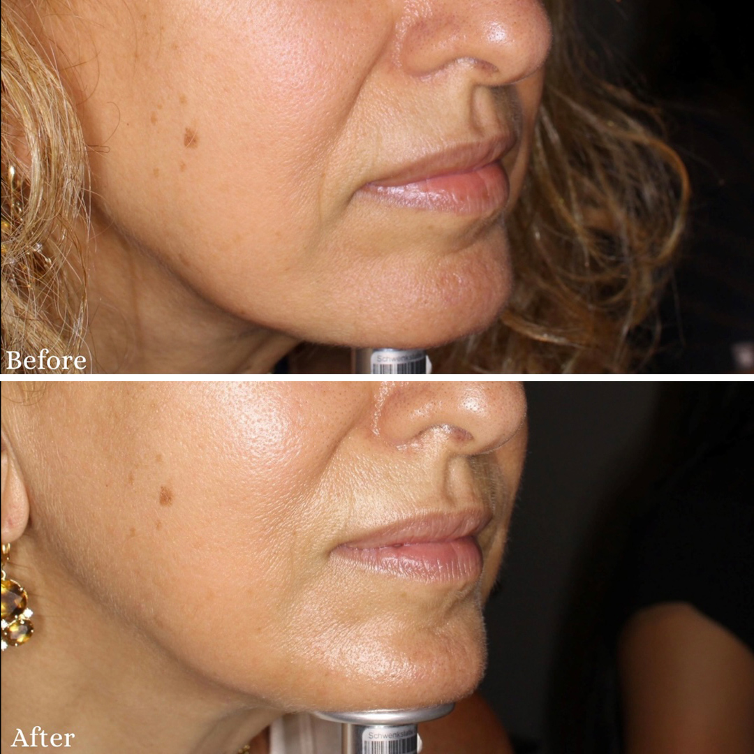 skinvive-by-juvederm-ba-1 Before and after image showing SKINVIVE results in Studio City.