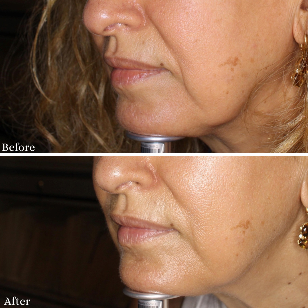 skinvive-by-juvederm-ba-2 Lower face before and after of SKINVIVE treatment in Studio City.